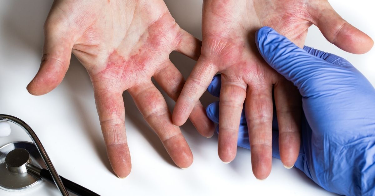 What is fiberglass dermatitis